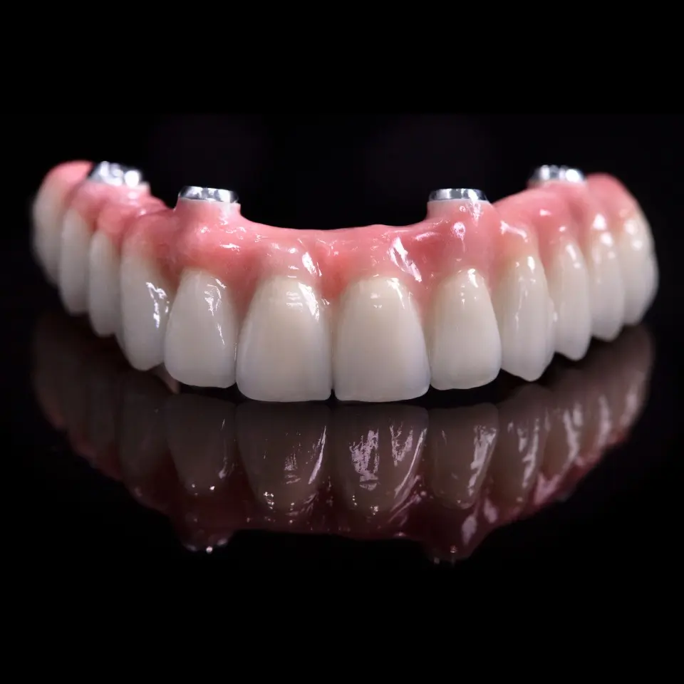 A full upper dental prosthesis with artificial teeth and pink gum, showing four metal implant abutments, displayed on a reflective black surface.