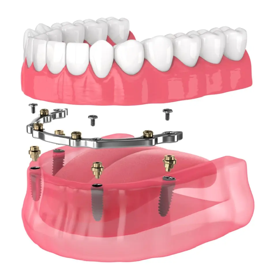 A 3D illustration showing a dental implant system with artificial teeth, a metal support bar, screws, and implants anchored into the lower jaw.