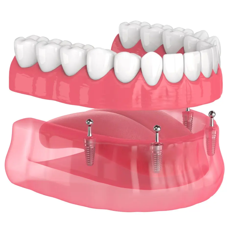 A digital illustration of a lower jaw shows dental implants with an overdenture above, depicting how the denture attaches to the implants.