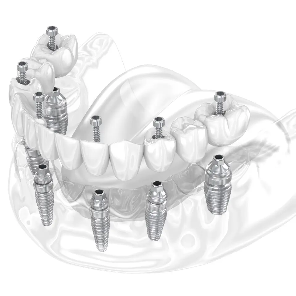 3D illustration showing a dental prosthesis with multiple dental implants and screws anchored in the upper and lower jaws.