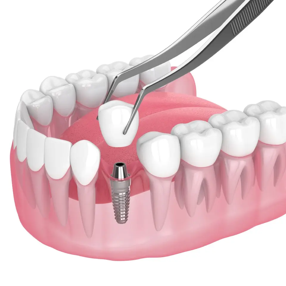 Illustration showing a dental implant being placed into the lower jaw, with tweezers positioning a crown onto the implant abutment among natural teeth.