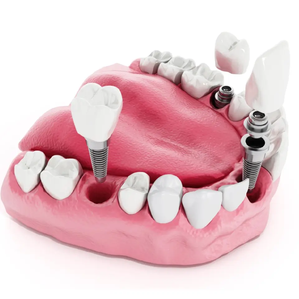 3D illustration of a dental implant procedure showing a gum model with teeth, missing tooth gaps, and two metal implants with crowns being placed.
