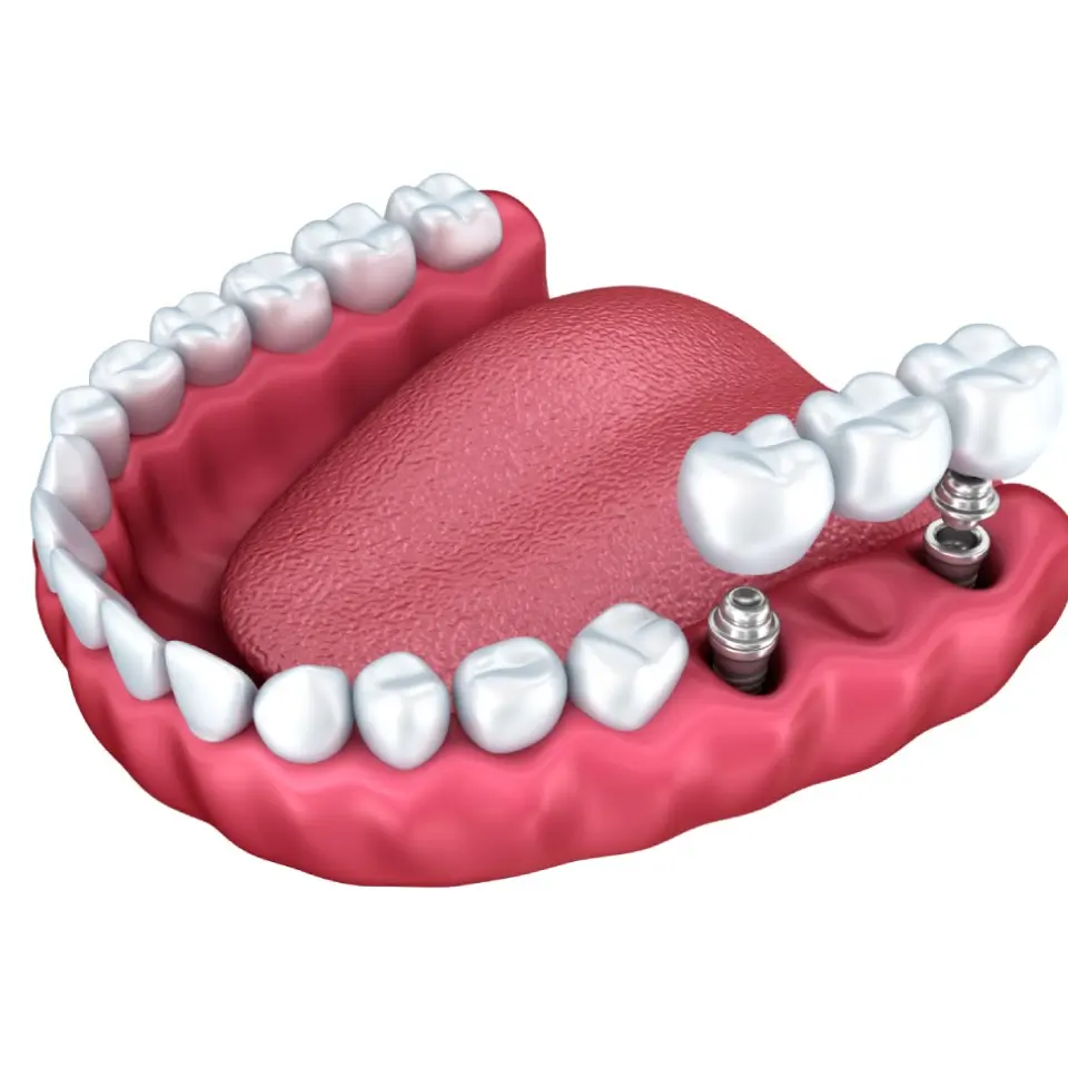 3D illustration of a lower dental arch with a bridge supported by two dental implants, replacing missing teeth near the molar area, with tongue visible in the background.