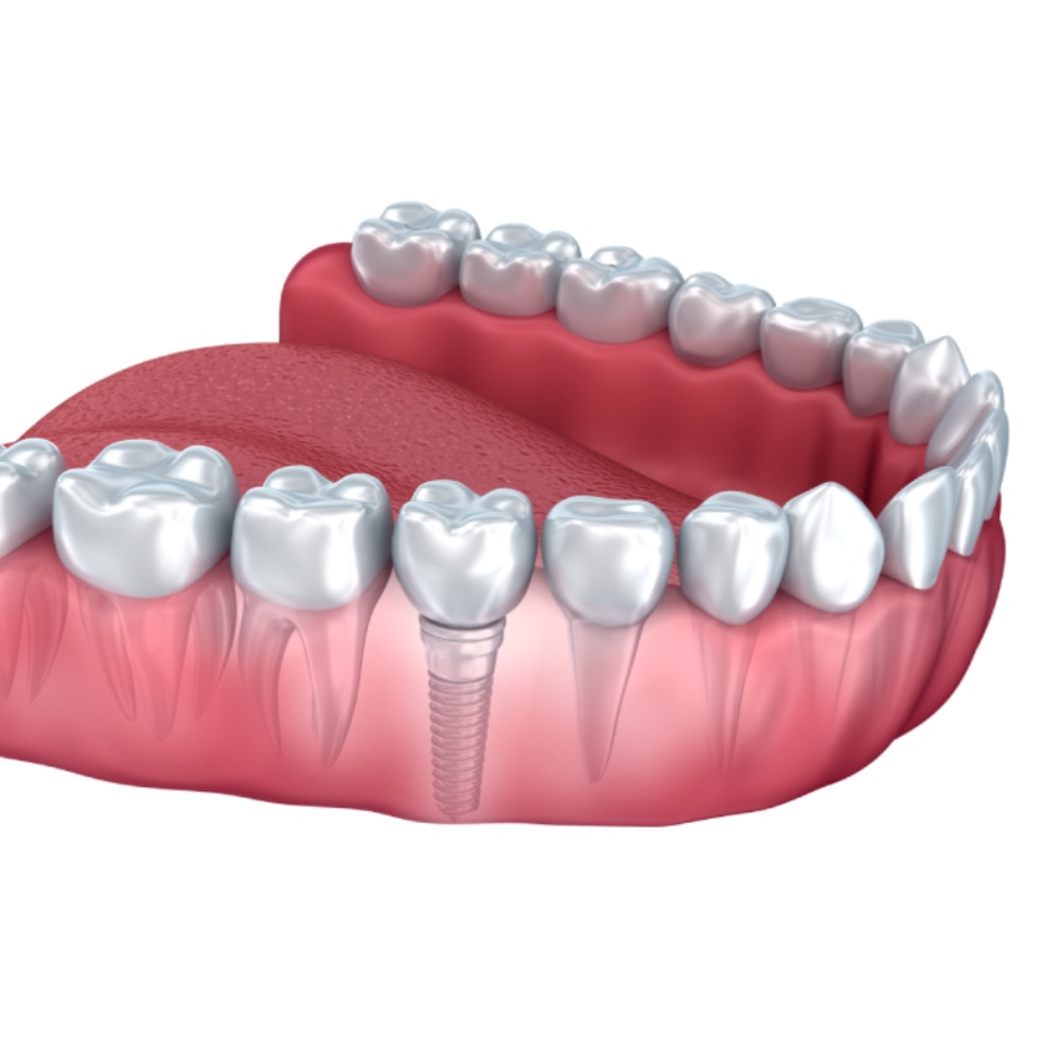 3D illustration of a lower jaw with teeth and gums, showing a dental implant replacing a missing tooth.