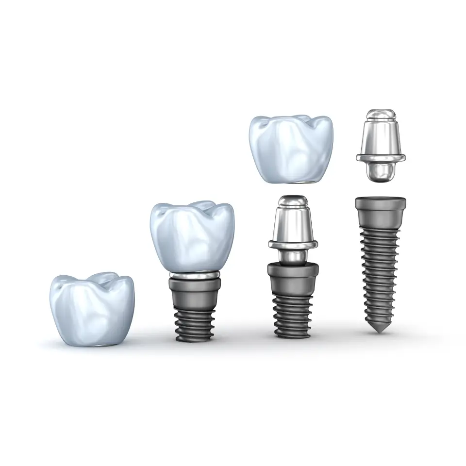 A diagram showing the components of dental implants, including a crown, abutment, and screw, displayed separately and assembled in sequence.