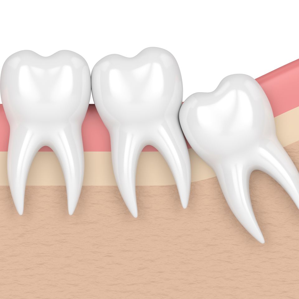 impacted teeth shutterstock 1084949864